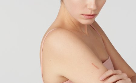 Peau atopique