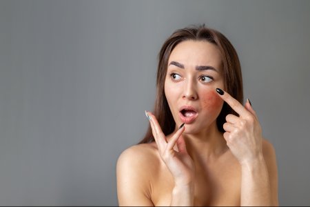 peau rosacée