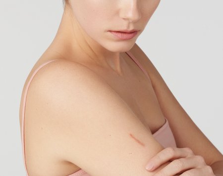 Peau atopique