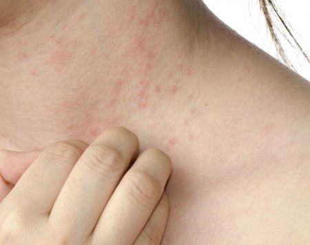 Scratching - Eczema
