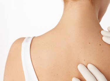 Hoe krijg je die bruine vlekken weg Hoe krijg je die bruine vlekken weg