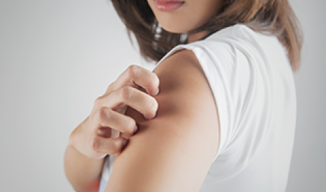 eczema atopique